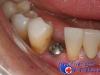 Что делать после имплантации зубов